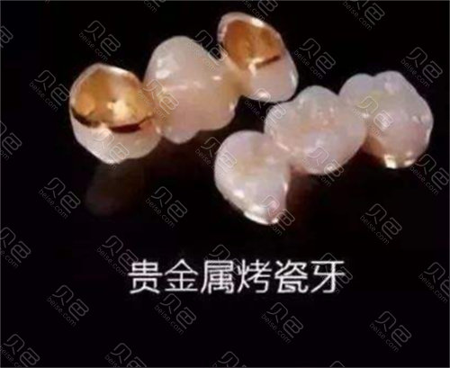 贵金属烤瓷牙的价格(贵金属烤瓷牙和全瓷牙价格)