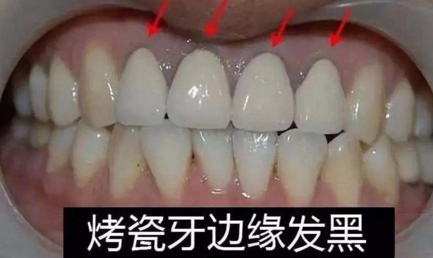 口腔贵金属(口腔贵金属有哪些)