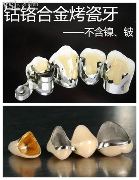 贵金属烤瓷牙(贵金属烤瓷牙有哪几种)