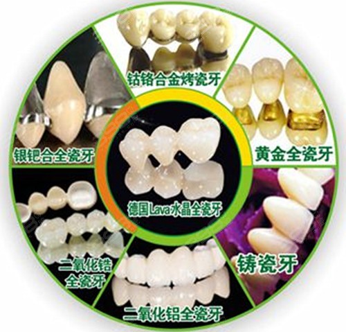 贵金属烤瓷牙价格(贵金属烤瓷牙是什么材质)