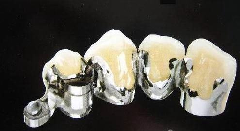 烤瓷牙贵金属(烤瓷牙贵金属与全瓷的区别)