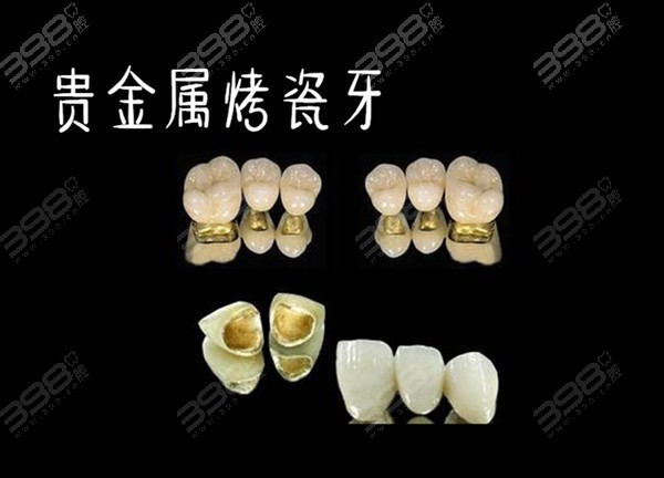 烤瓷牙贵金属(烤瓷牙贵金属与全瓷的区别)