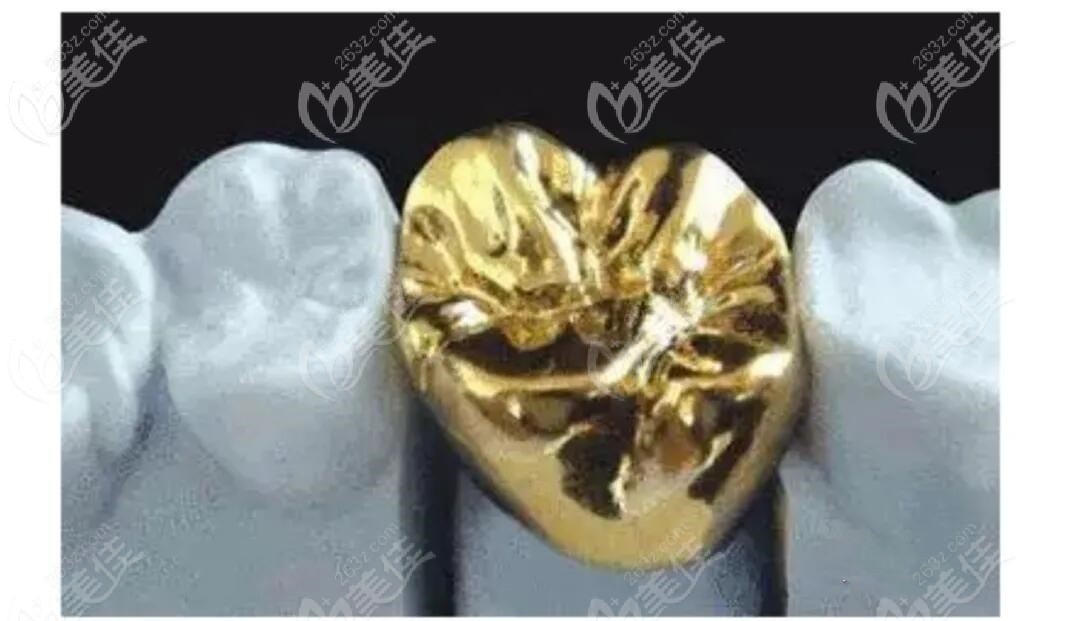 贵金属牙(贵金属牙套能不能做磁共振)