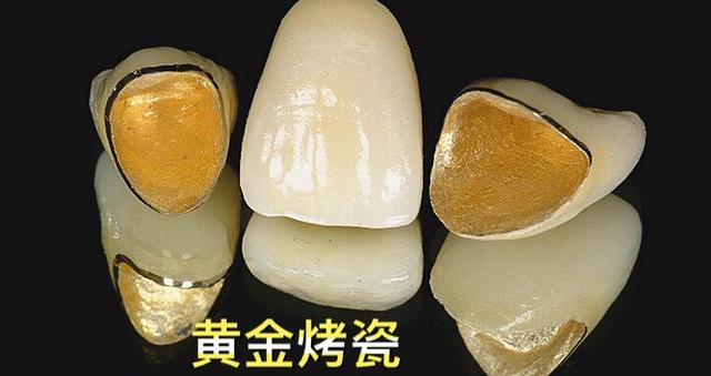 贵金属牙(贵金属牙套能不能做磁共振)
