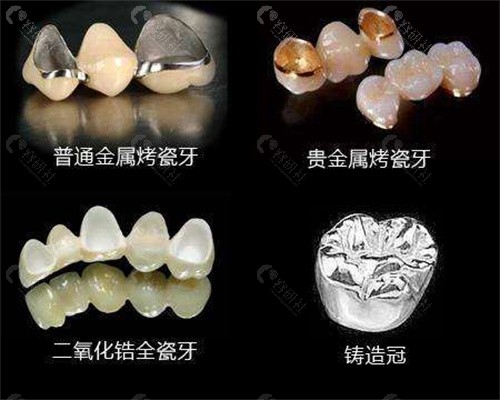 烤瓷牙贵金属(烤瓷牙贵金属和普通金属怎么看)