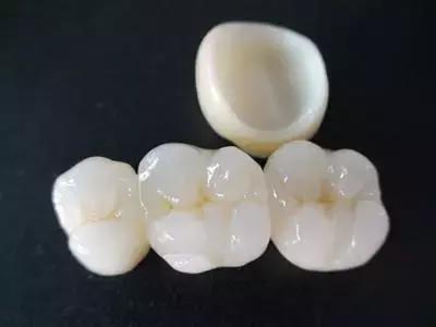 贵金属瓷牙(贵金属烤瓷牙是什么材质)