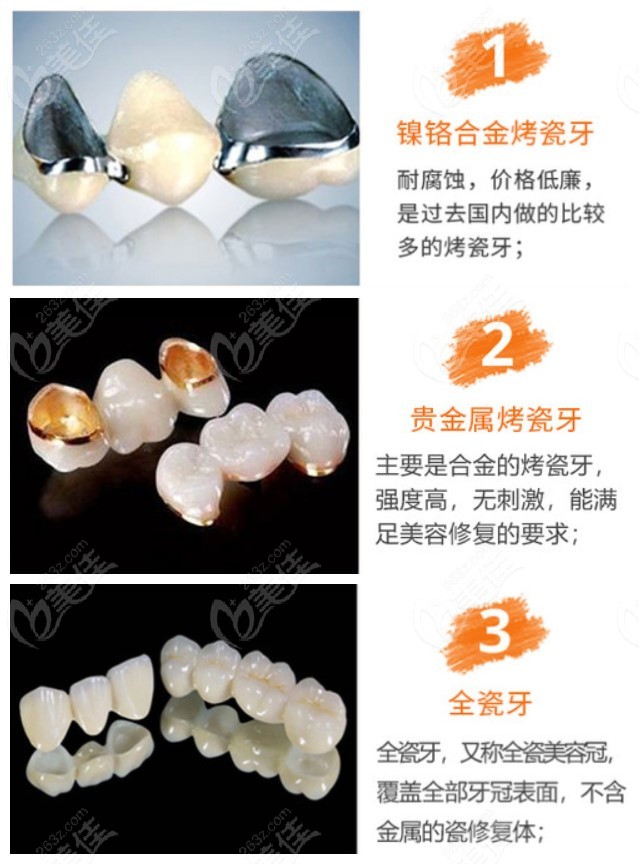 贵金属烤瓷牙价格(贵金属烤瓷牙价格表)