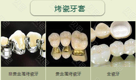 贵金属牙(贵金属牙冠多少钱一颗)