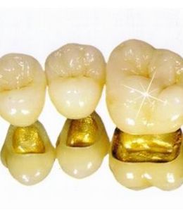贵金属牙(贵金属牙冠多少钱一颗)