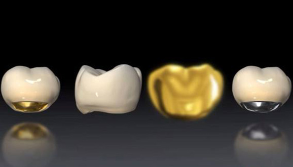 烤瓷牙贵金属(烤瓷牙贵金属多少钱一颗)