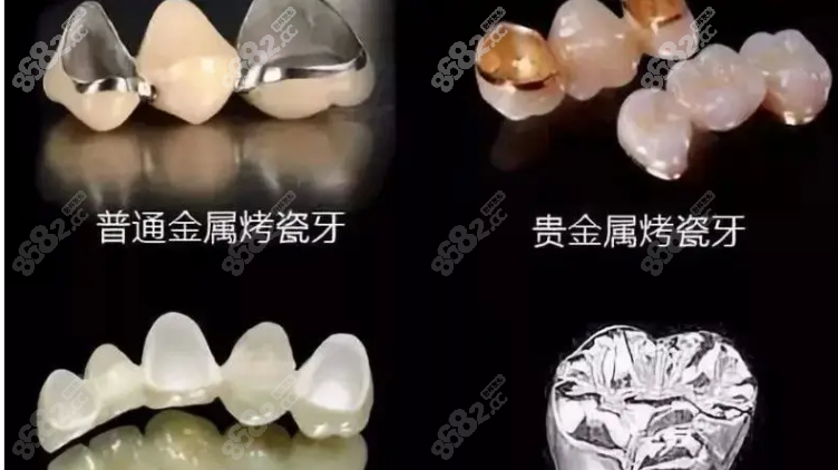 贵金属烤瓷牙(贵金属烤瓷牙是什么意思)