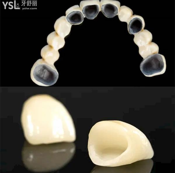 贵金属烤瓷牙(贵金属烤瓷牙可以做核磁共振吗)