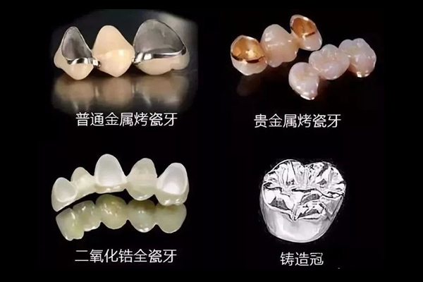 贵金属烤瓷牙(贵金属烤瓷牙可以做核磁共振吗)
