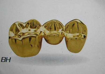 烤瓷牙贵金属(烤瓷牙贵金属和非贵金属厚度)