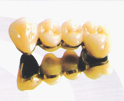 烤瓷牙贵金属(烤瓷牙贵金属和合金的区别)
